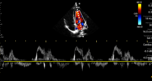 Pulsed wave Doppler
